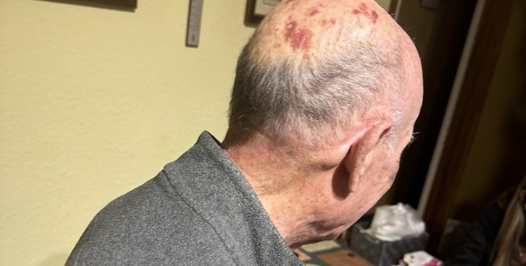 La família ha difós una imatge de l'avi amb les marques als ulls de la pallissa | @bertusSBD