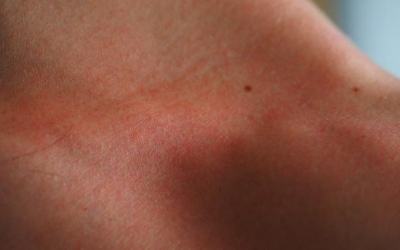 Imatge d'una cremada solar/ Cedida