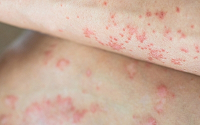 Una persona afectada per hidradenitis supurativa/ Cedida