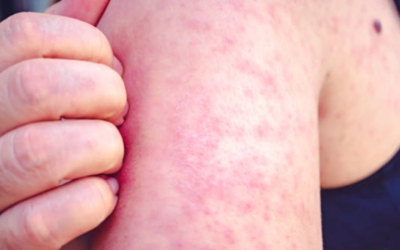 Una persona afectada per xarampió | Pexels